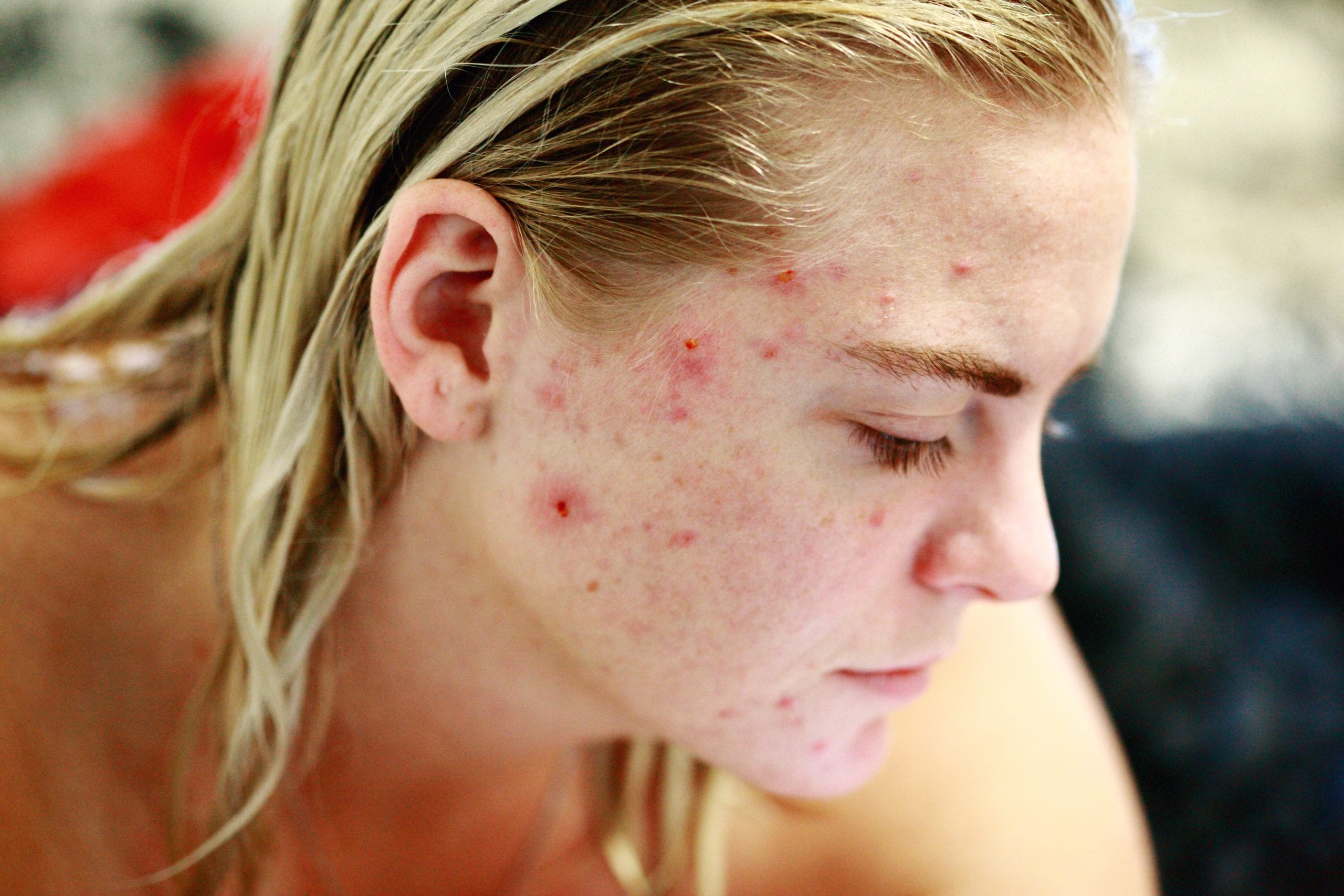 What is it About Steroids and Acne